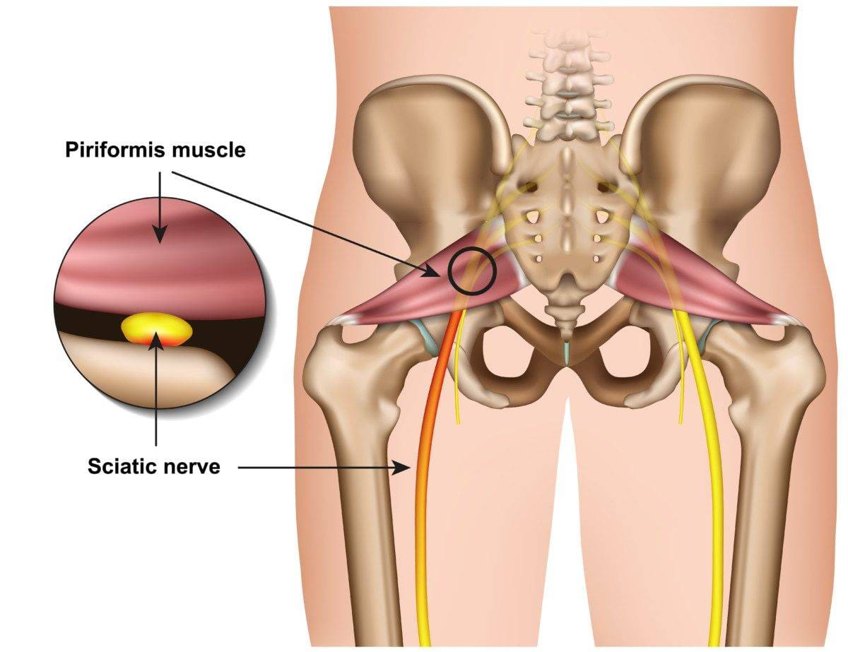 piriformis syndrome 3d medical vector illustration on white background